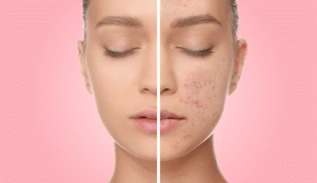 blizny potrądzikowe