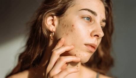 najlepsze suplementy i diety na walkę z trądzikiem