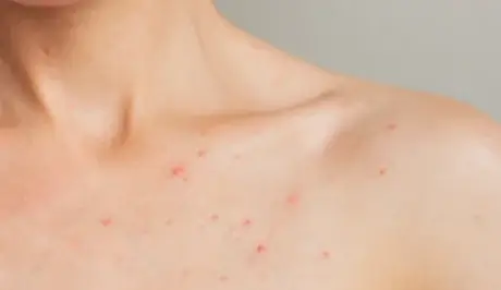 zdrowy wygląd skóry przy zmianach hormonalnych