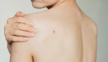 zaburzenia hormonalne a kondycja skóry